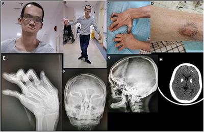 Case Report: Aicardi-Goutières Syndrome and Singleton-Merten Syndrome Caused by a <mark class="highlighted">Gain-of-Function Mutation</mark> in IFIH1